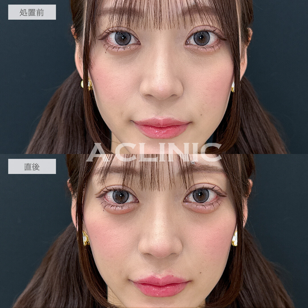 ヒアルで即日手軽に中顔面短縮！涙袋形成術(ヒアルロン酸)とリップヒアルロン酸注入の処置前と直後の症例です(20代女性)