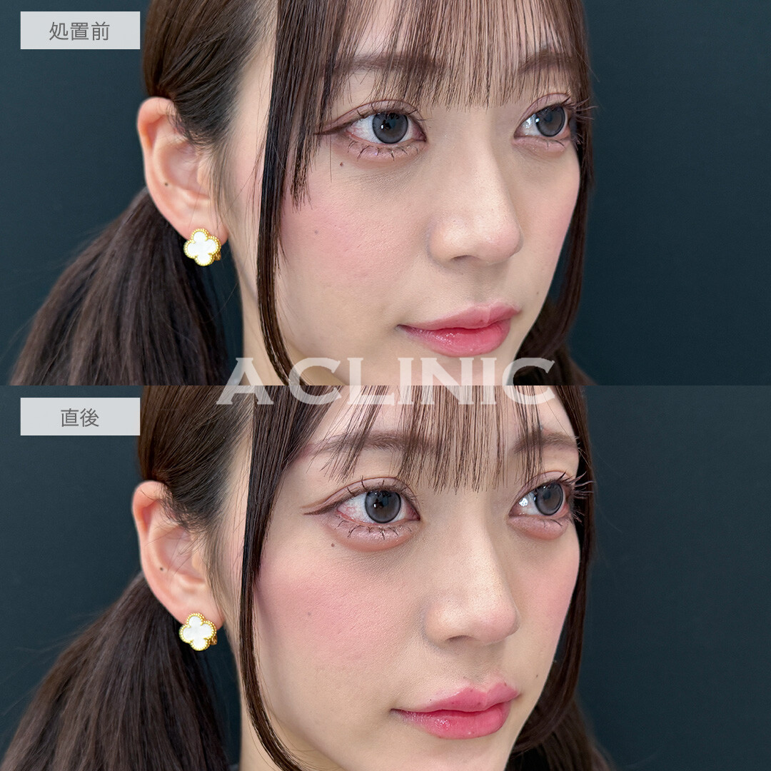 ヒアルで即日手軽に中顔面短縮！涙袋形成術(ヒアルロン酸)とリップヒアルロン酸注入の処置前と直後の症例です(20代女性)