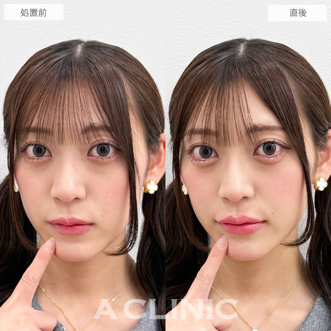 ヒアルで即日手軽に中顔面短縮！涙袋形成術(ヒアルロン酸)とリップヒアルロン酸注入の処置前と直後の症例です(20代女性)