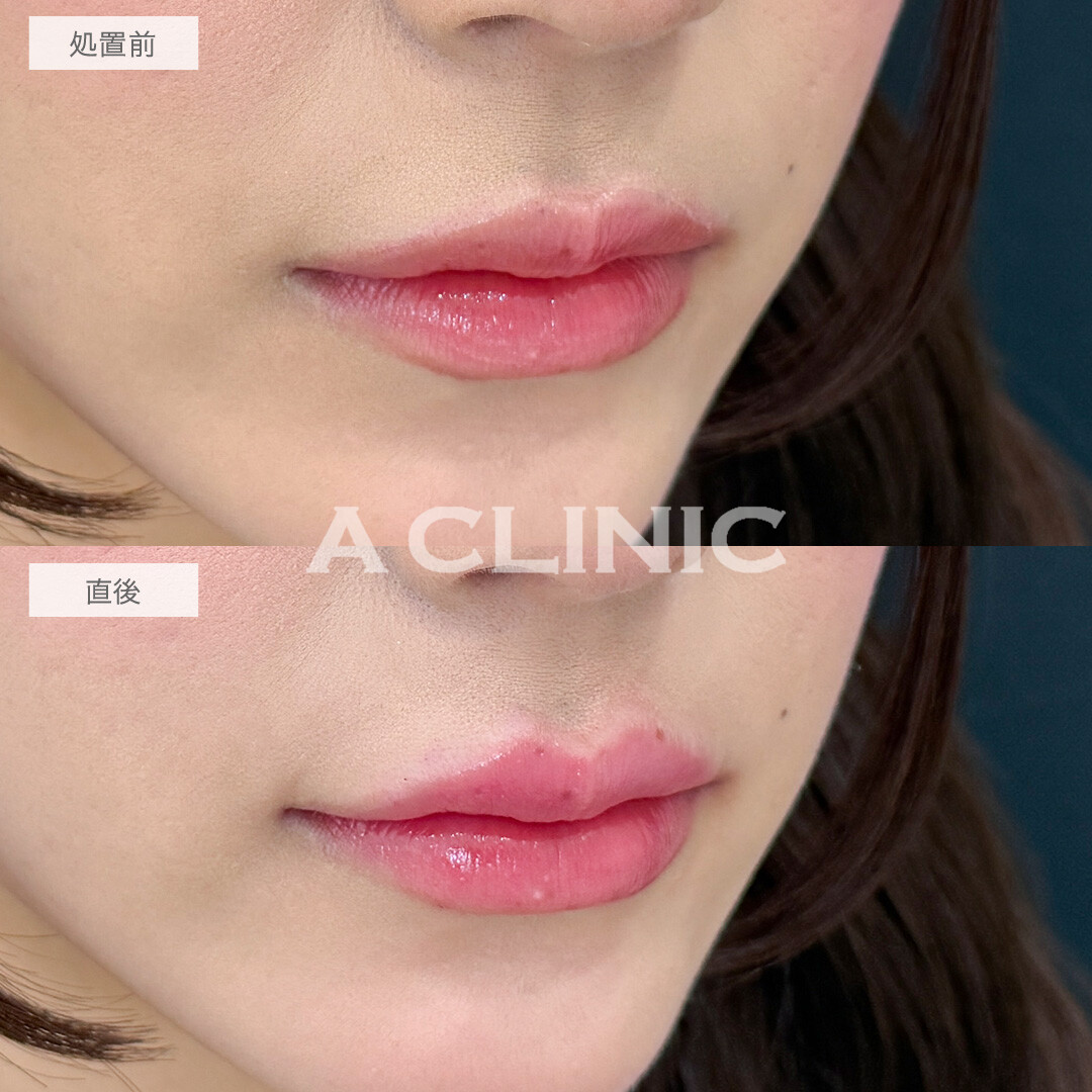 ヒアルで即日手軽に中顔面短縮！涙袋形成術(ヒアルロン酸)とリップヒアルロン酸注入の処置前と直後の症例です(20代女性)