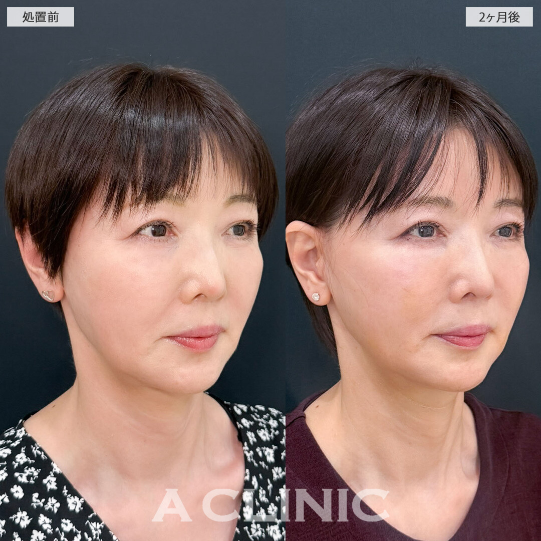 A式ナゾラリフトで口周りのたるみを引き上げ若々しく！こちら処置前と2ヶ月後の症例です(60代女性)