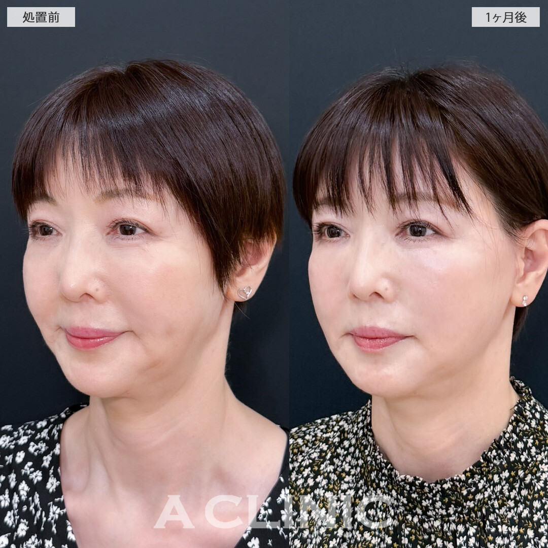 A式ナゾラリフトはほうれい線まわりのお悩みに特化した施術です！こちら処置前と1ヶ月後の症例です(60代女性)
