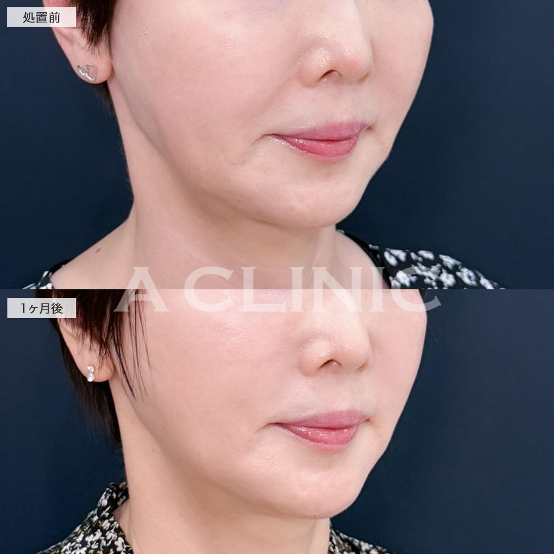 A式ナゾラリフトはほうれい線まわりのお悩みに特化した施術です！こちら処置前と1ヶ月後の症例です(60代女性)