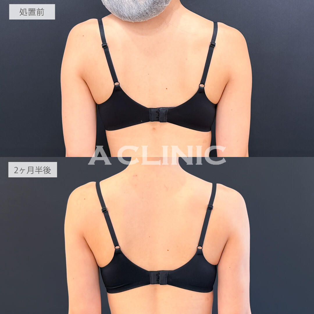 二の腕スリム脂肪吸引で二の腕に肉が付きにくくなりました！処置前と2ヶ月半後の症例です(20代女性)