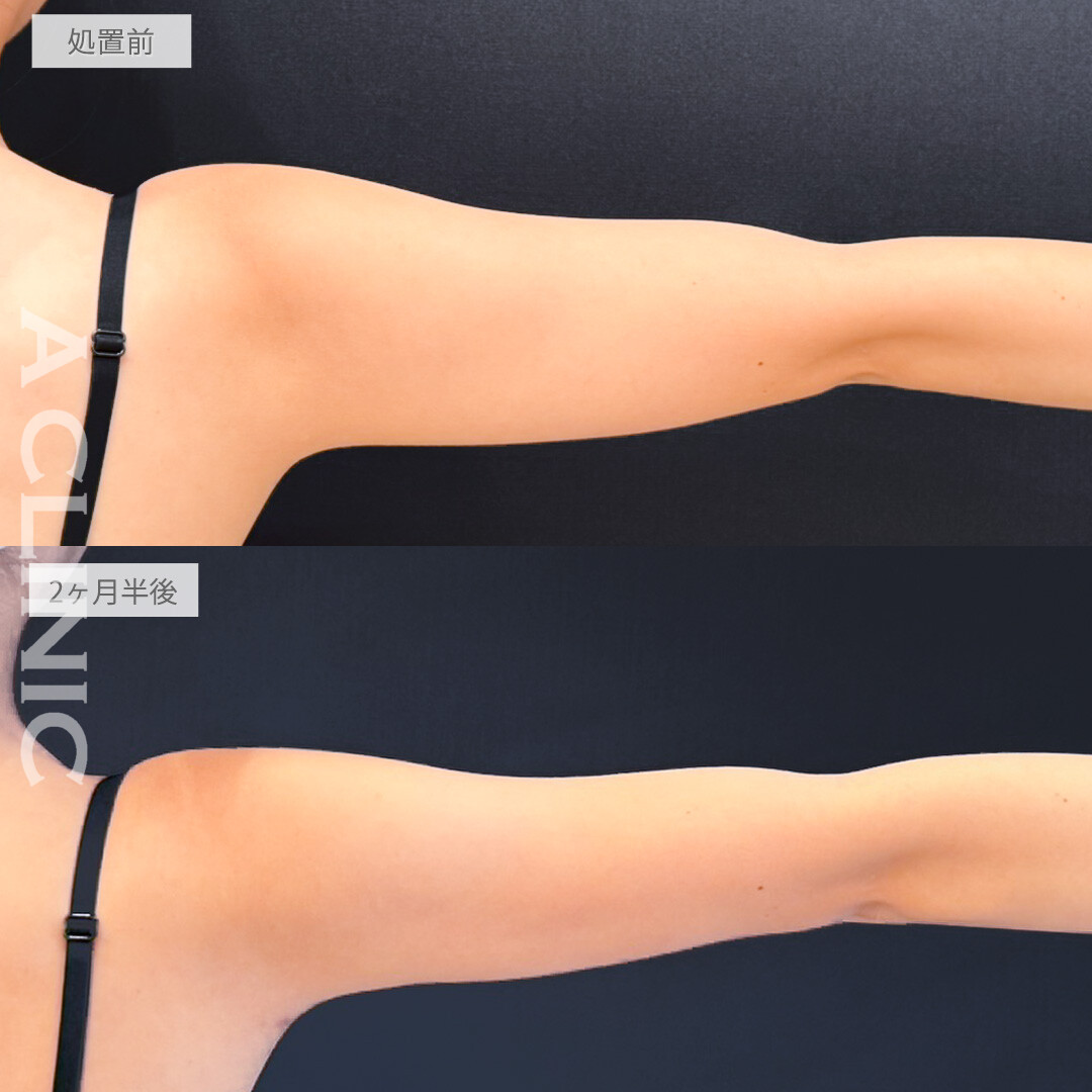 二の腕スリム脂肪吸引で二の腕に肉が付きにくくなりました！処置前と2ヶ月半後の症例です(20代女性)