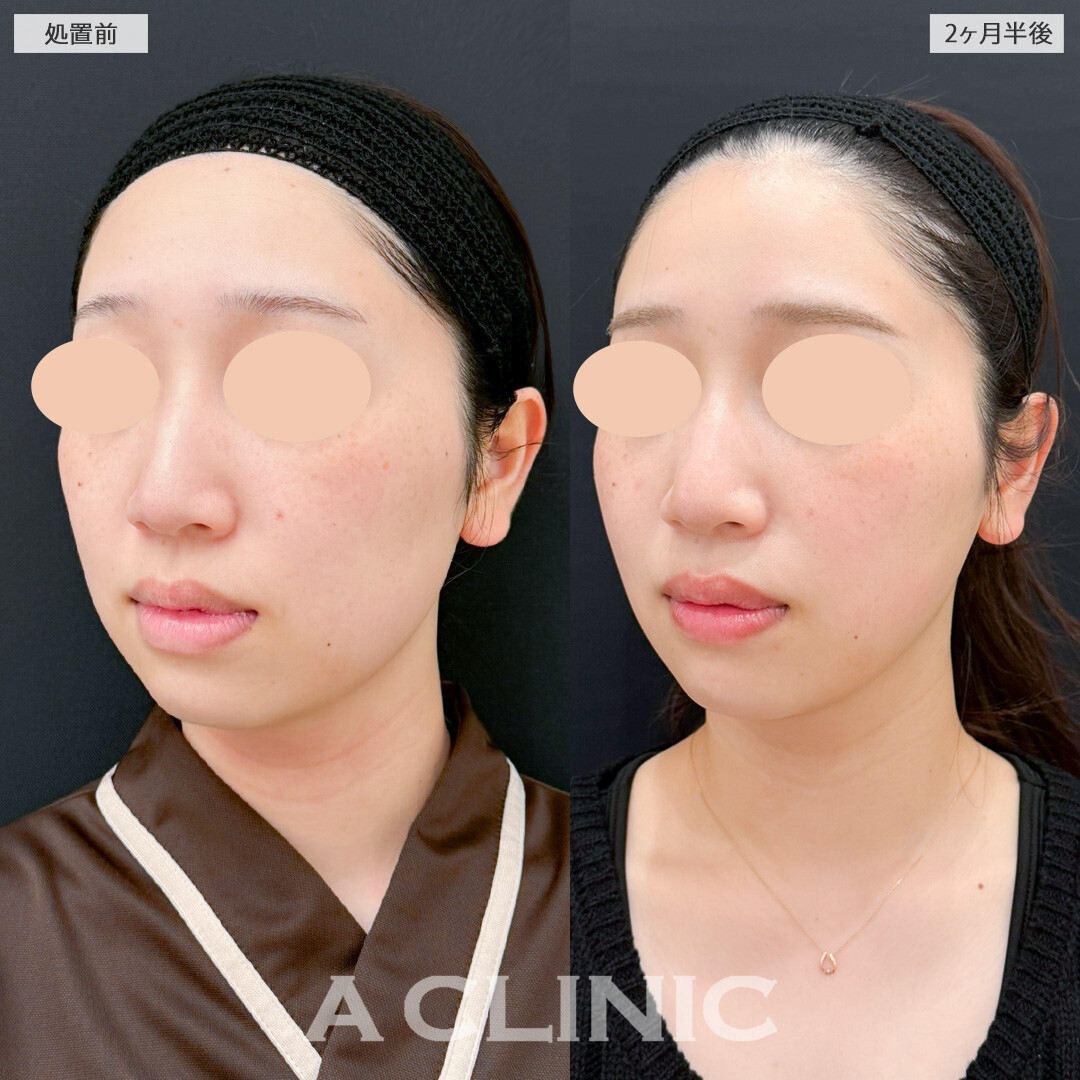 1day小顔脂肪吸引と小顔エラボトックスでスッキリさせつつ自然な仕上がりでお顔のクオリティを上げられます！処置前と2ヶ月半後の症例です(20代女性)