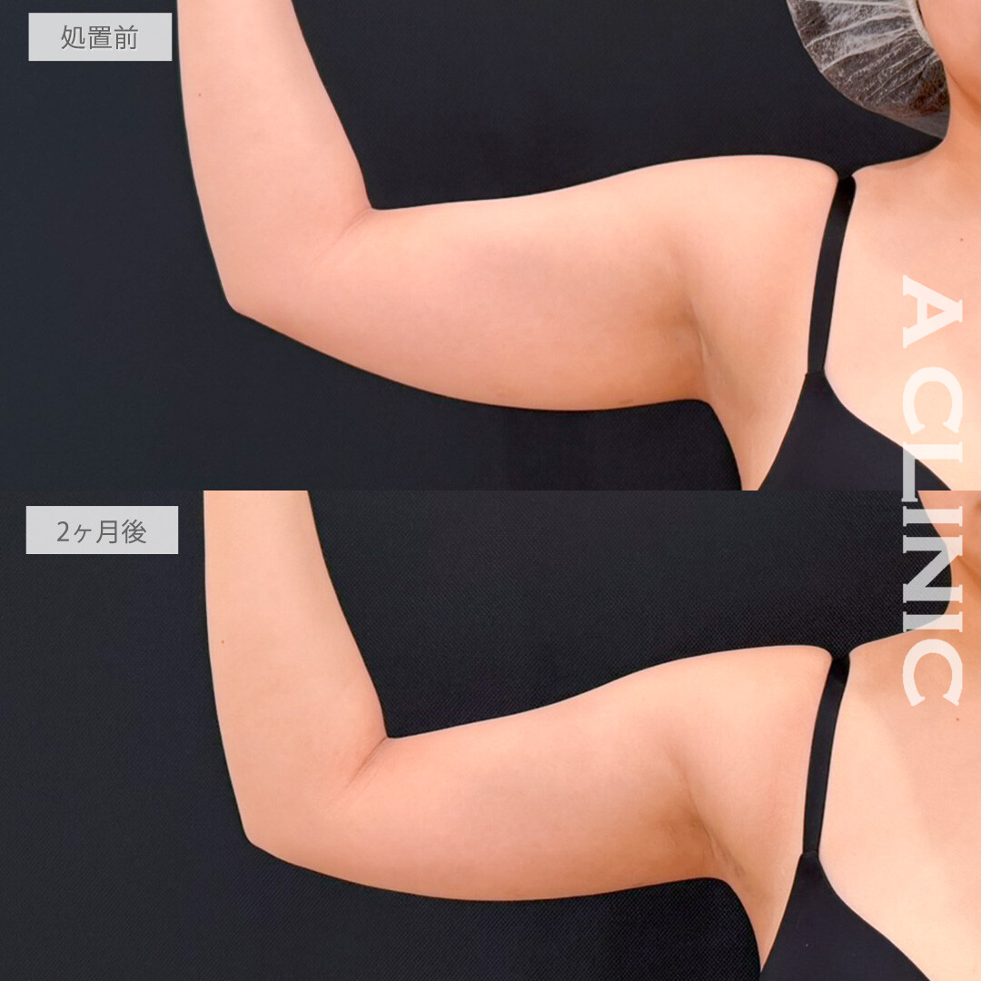 二の腕スリム脂肪吸引で骨格ストレートさんでも憧れのスッキリ二の腕になれました！処置前と2ヶ月後の症例です(20代女性)