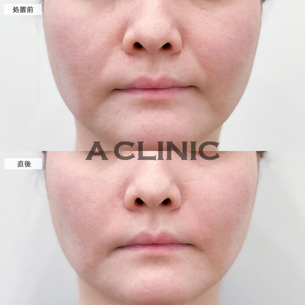 ヒアルロン酸注射(シワ)は若返りに最適！こちら処置前と直後の症例です(30代女性)