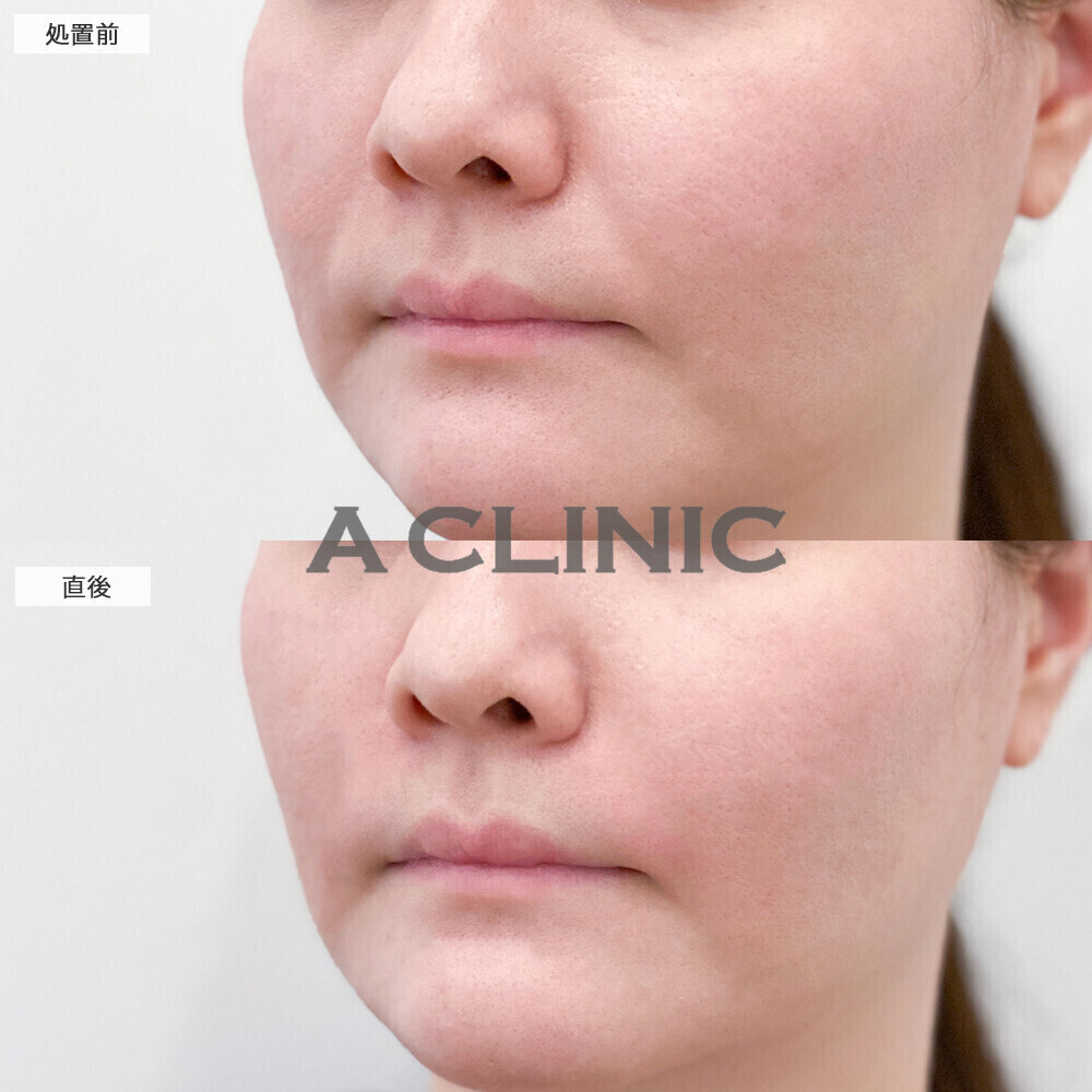 ヒアルロン酸注射(シワ)は若返りに最適！こちら処置前と直後の症例です(30代女性)