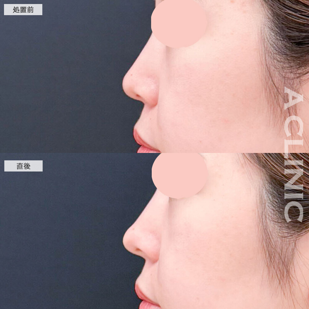 鼻ヒアルロン酸で横顔も映える自然なアップノーズに変化！こちら処置前と直後の症例です(20代女性)