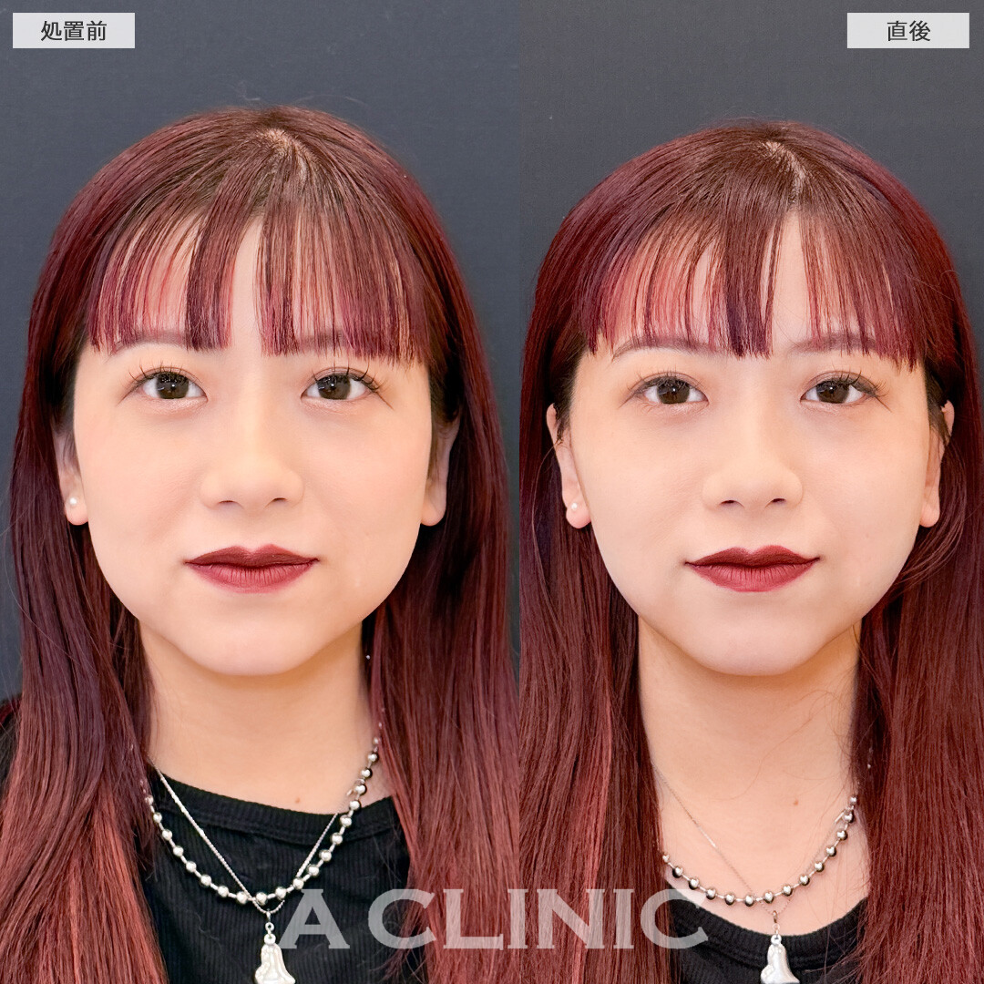 1day小顔脂肪吸引は直後から即小顔になれる施術です！こちら処置前と直後の症例です(20代女性)