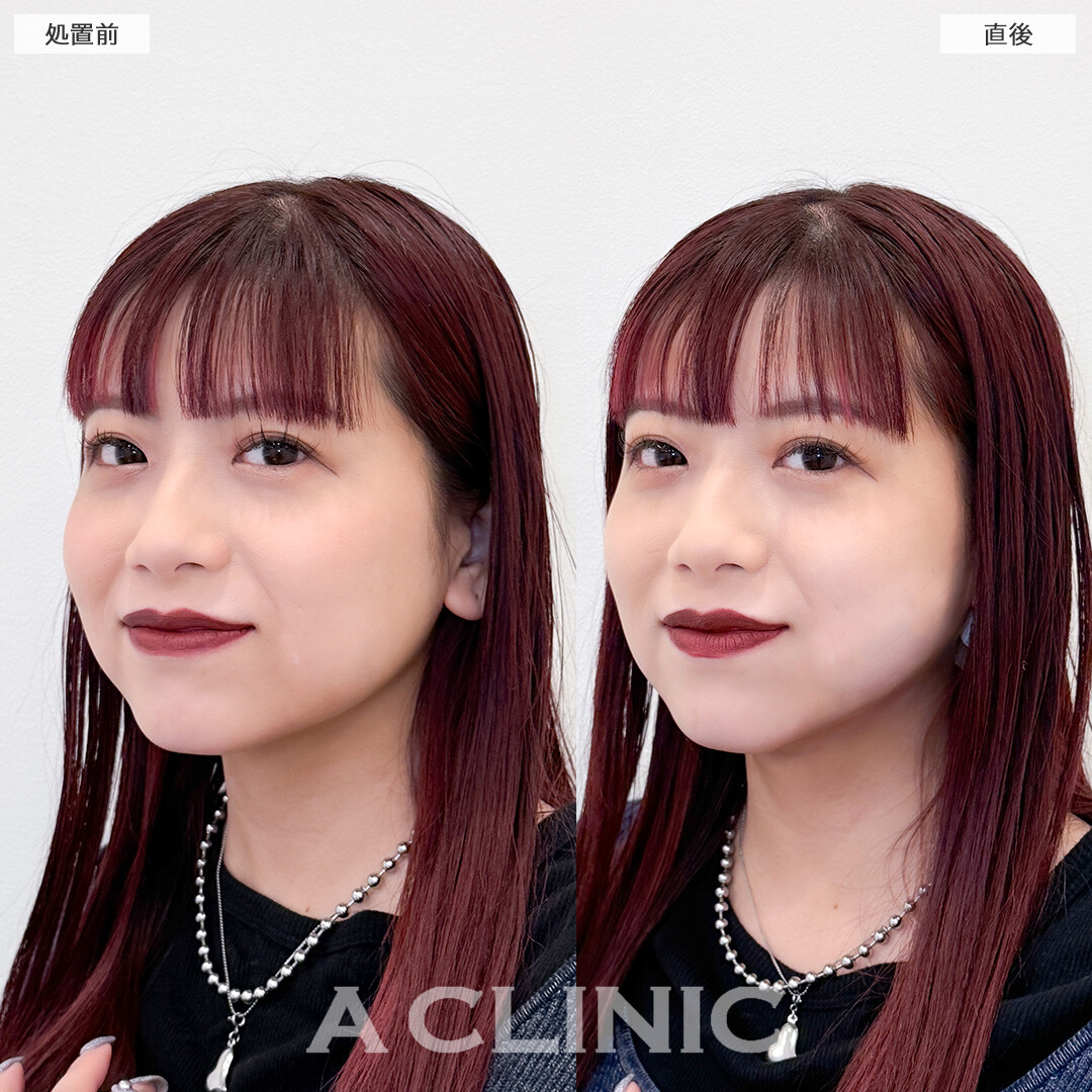 1day小顔脂肪吸引は直後から即小顔になれる施術です！こちら処置前と直後の症例です(20代女性)