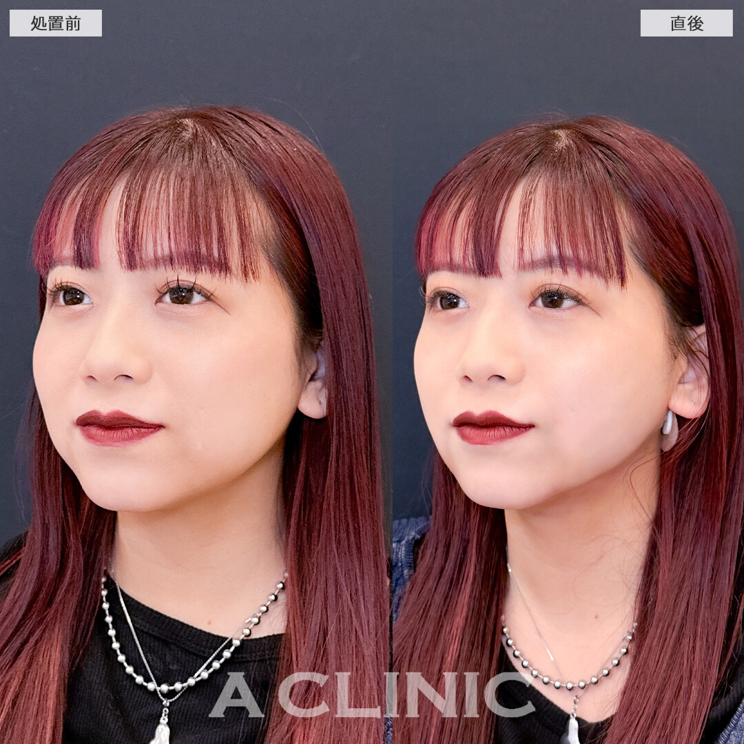 1day小顔脂肪吸引は直後から即小顔になれる施術です！こちら処置前と直後の症例です(20代女性)