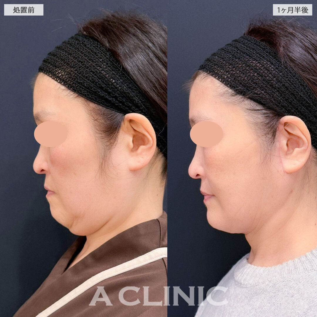 1day小顔脂肪吸引とA式美肌たるみ切開を組み合わせてたるみをスッキリさせ小顔になれました！こちら処置前と1か月半後の症例です(50代女性)