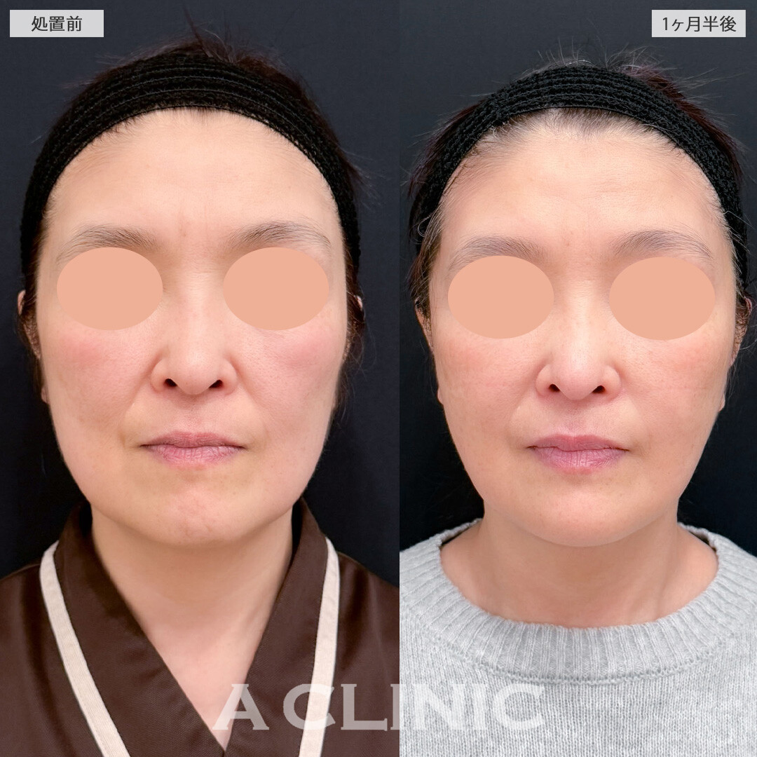 1day小顔脂肪吸引とA式美肌たるみ切開を組み合わせてたるみをスッキリさせ小顔になれました！こちら処置前と1か月半後の症例です(50代女性)