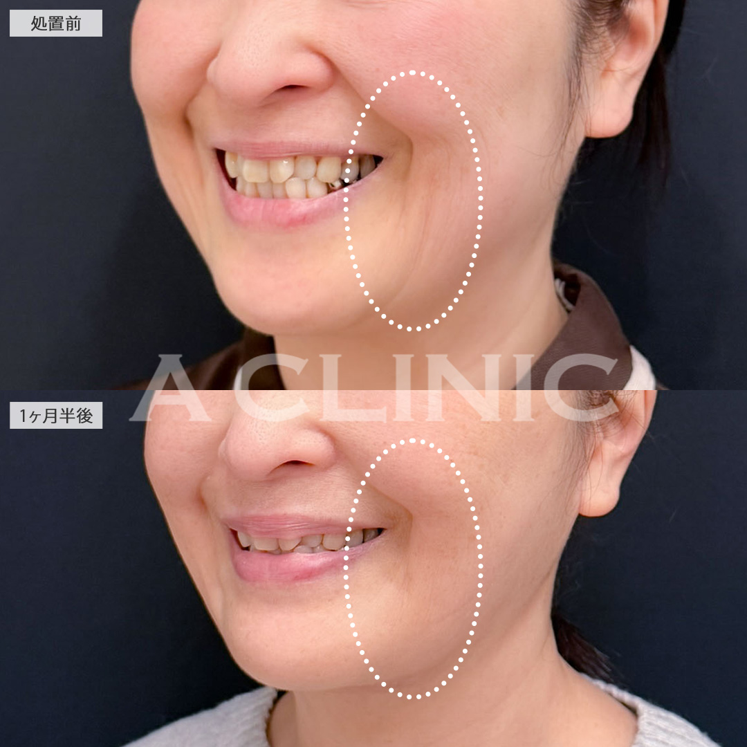 1day小顔脂肪吸引とA式美肌たるみ切開を組み合わせてたるみをスッキリさせ小顔になれました！こちら処置前と1か月半後の症例です(50代女性)