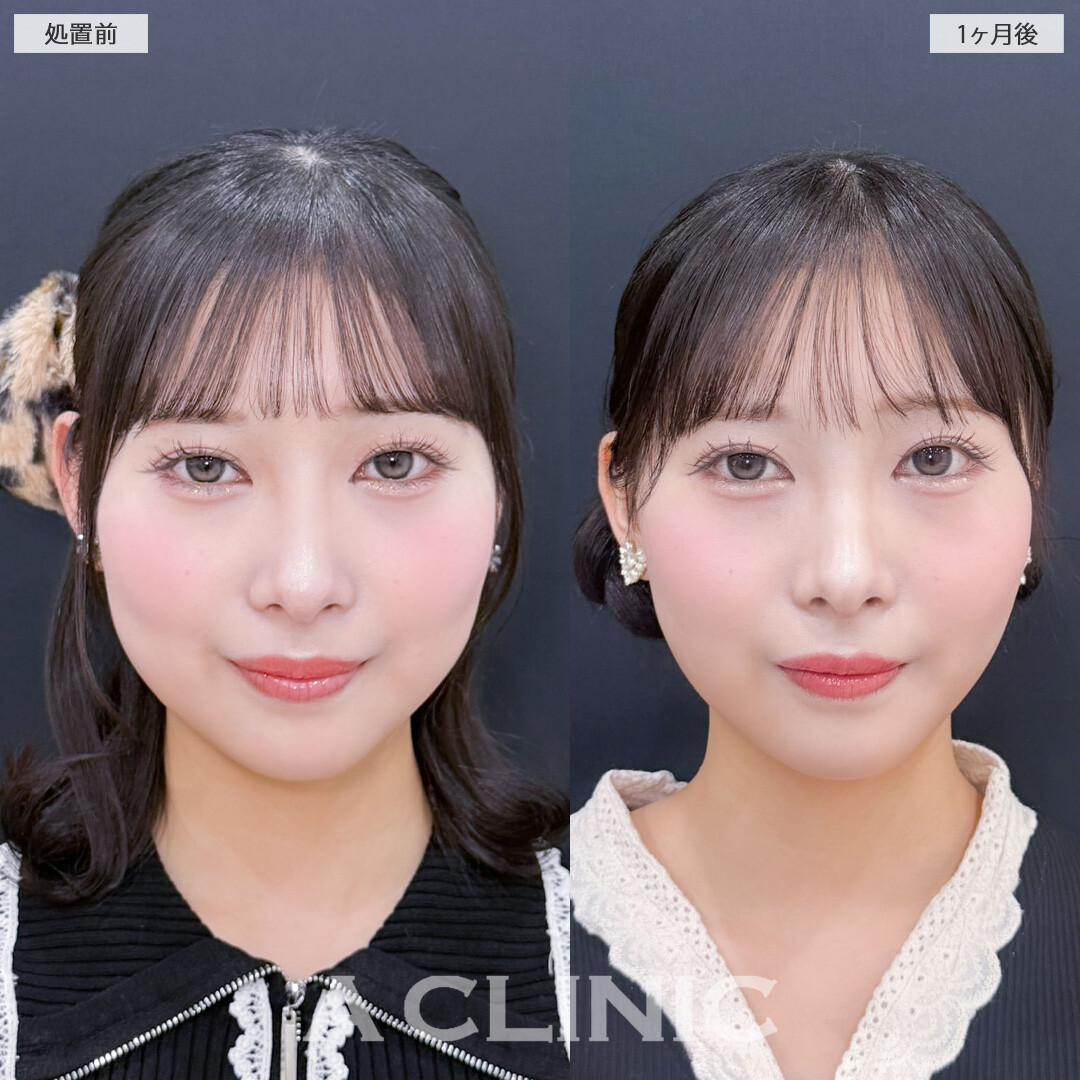 1day小顔脂肪吸引で小顔になって余白が減りました！こちら処置前と1ヶ月後の症例です(20代女性)