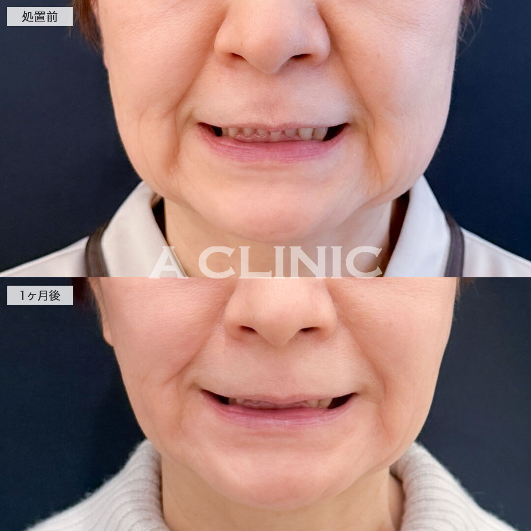 1day小顔脂肪吸引は若返りにも大きな効果が期待できる施術です！こちら処置前と1ヶ月後の症例です(60代女性)