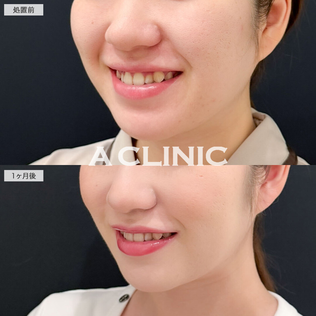 1day小顔脂肪吸引でお顔のボリューム感を減らして垢抜け！こちら処置前と1ヶ月後の症例です(20代女性)