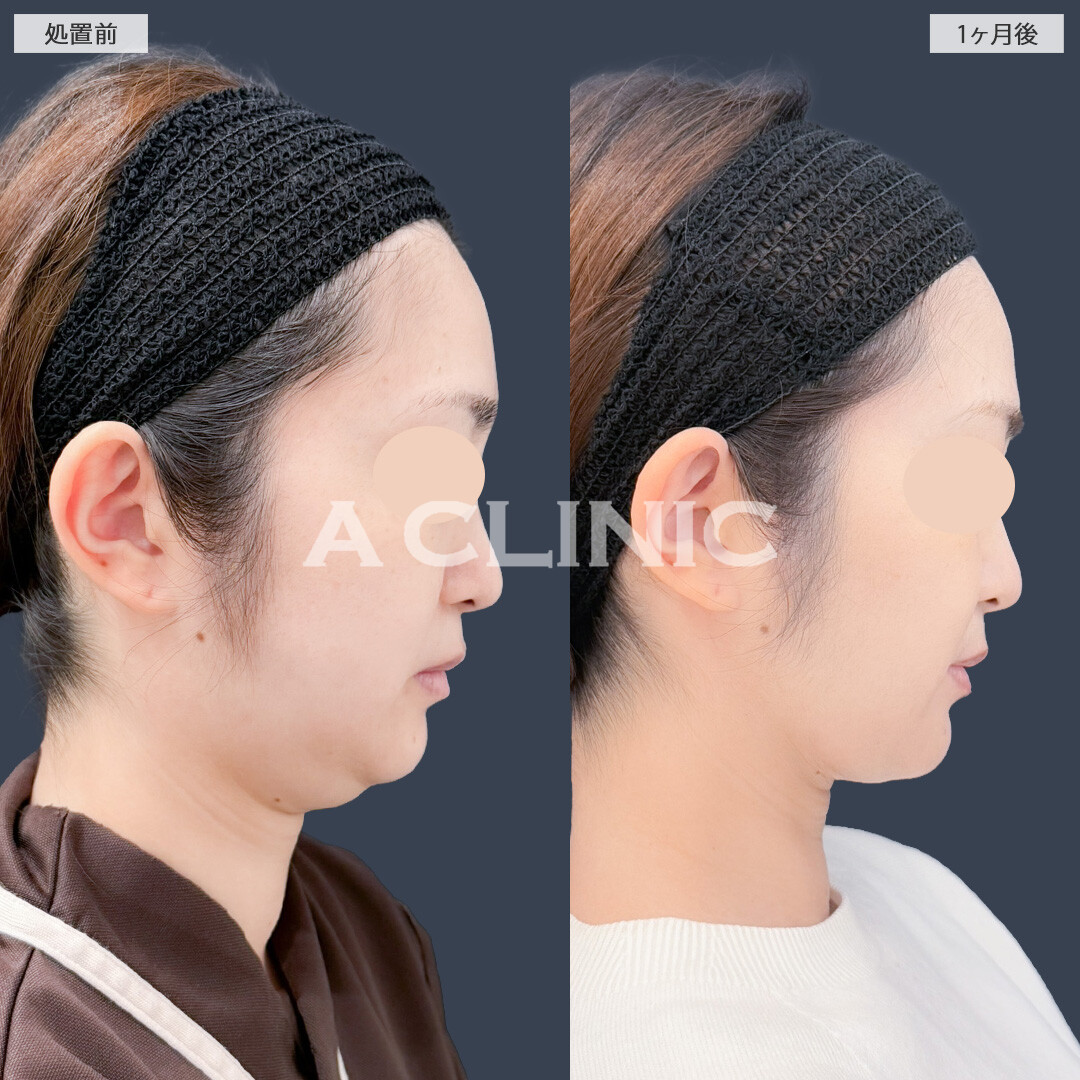 1day小顔脂肪吸引とバッカルファット除去術で余分な脂肪を減らしてすっきりVフェイスに！こちら処置前と1ヶ月後の症例です(30代女性)