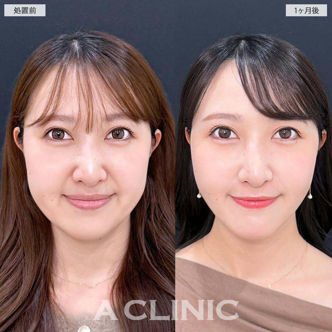 1day小顔脂肪吸引で小顔になって美しさUPしました！こちら処置前と1か月後の症例です(30代女性)