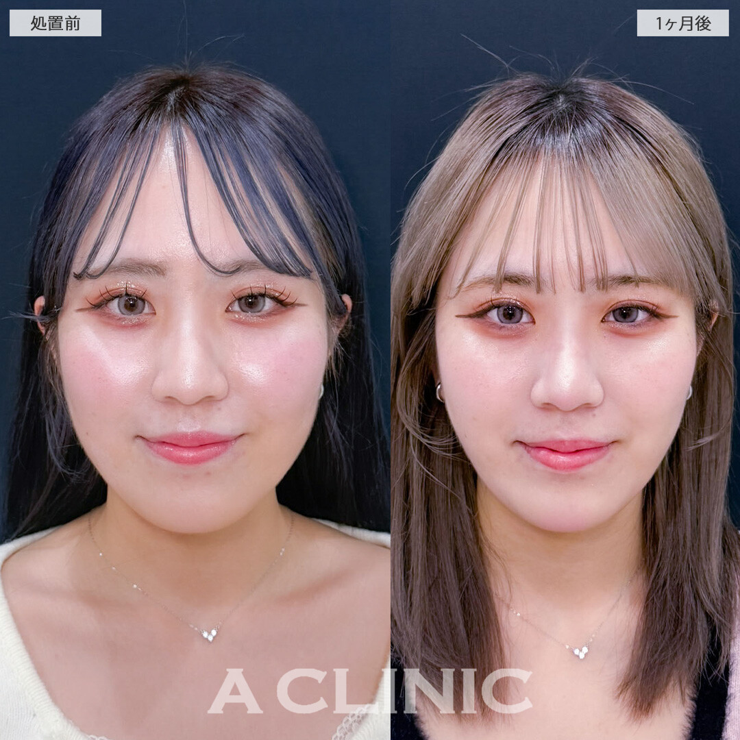 1day小顔脂肪吸引でぷにっと感を無くしてシュッと小顔に！こちら処置前と1ヶ月後の症例です(20代女性)