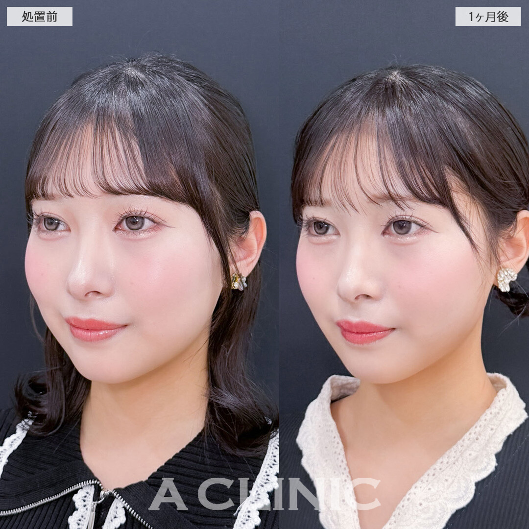 1day小顔脂肪吸引で小顔になって余白が減りました！こちら処置前と1ヶ月後の症例です(20代女性)