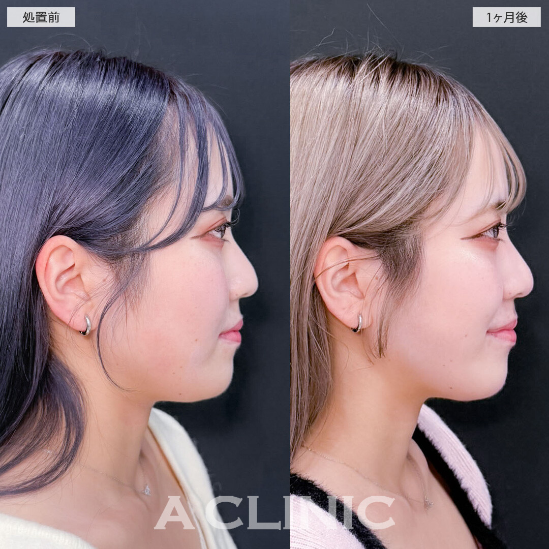 1day小顔脂肪吸引でぷにっと感を無くしてシュッと小顔に！こちら処置前と1ヶ月後の症例です(20代女性)