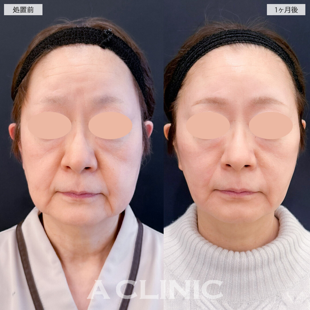 1day小顔脂肪吸引は若返りにも大きな効果が期待できる施術です！こちら処置前と1ヶ月後の症例です(60代女性)