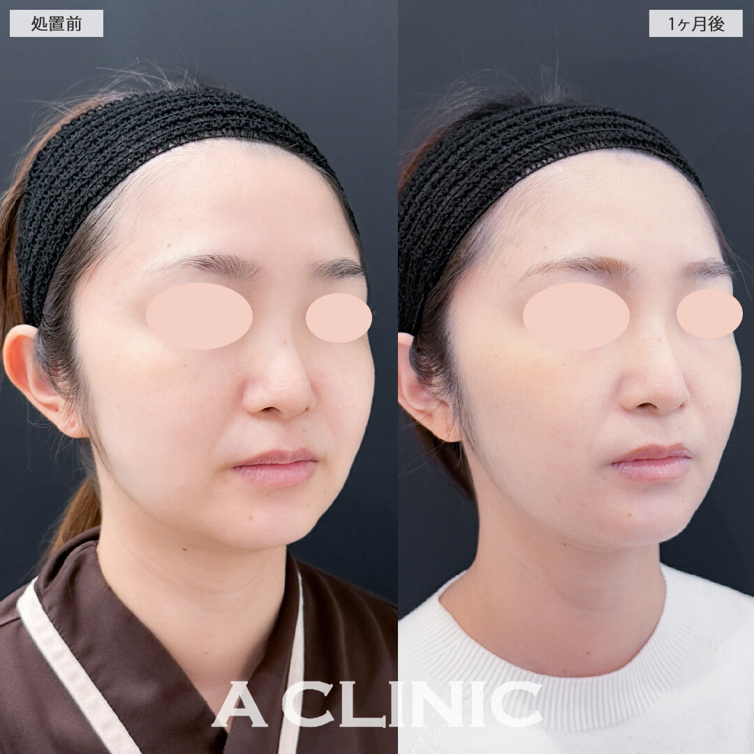 1day小顔脂肪吸引とバッカルファット除去術で余分な脂肪を減らしてすっきりVフェイスに！こちら処置前と1ヶ月後の症例です(30代女性)