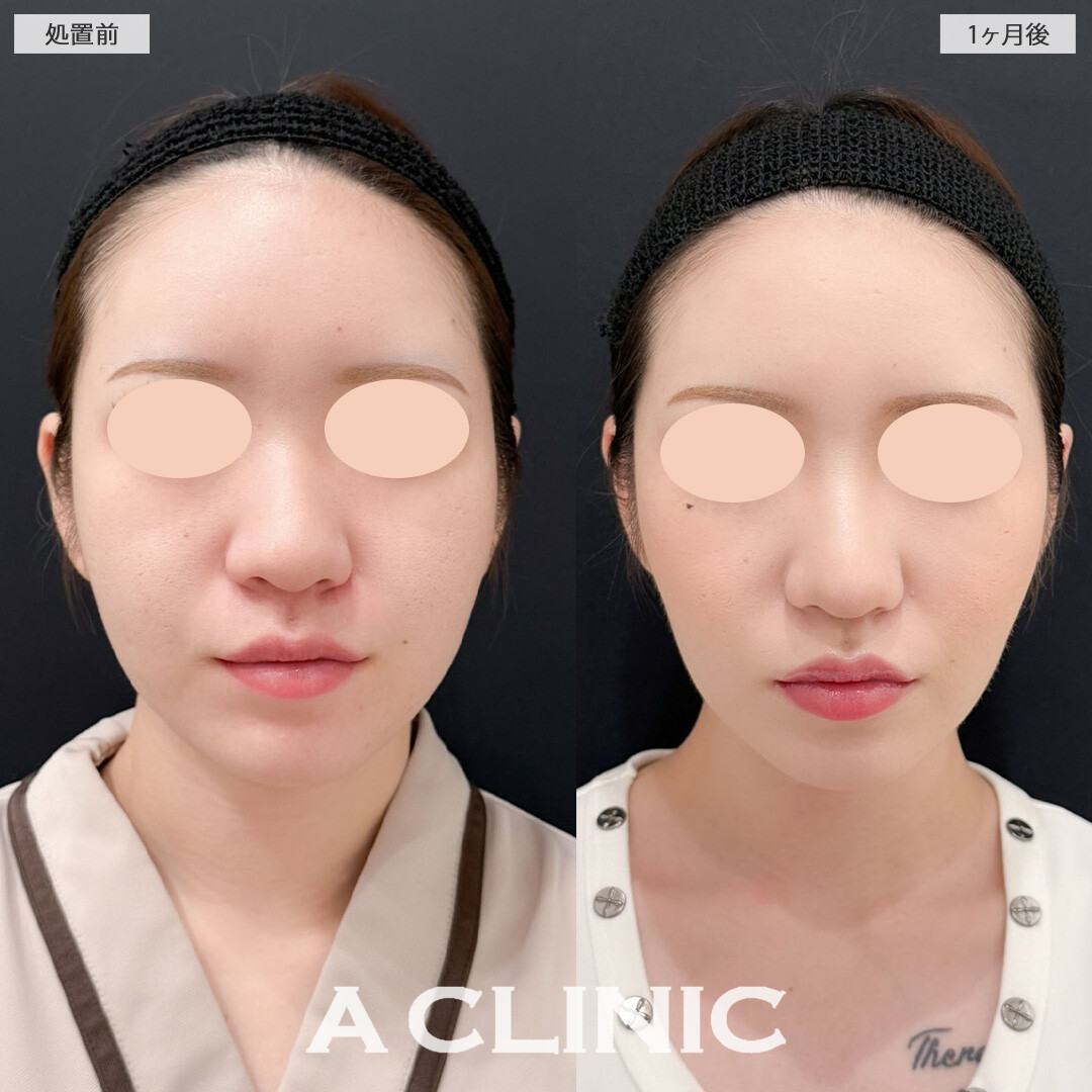 1day小顔脂肪吸引でお顔のボリューム感を減らして垢抜け！こちら処置前と1ヶ月後の症例です(20代女性)