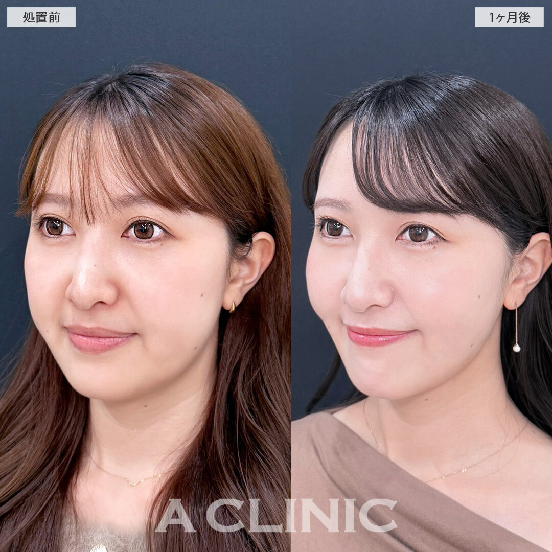 1day小顔脂肪吸引で小顔になって美しさUPしました！こちら処置前と1か月後の症例です(30代女性)