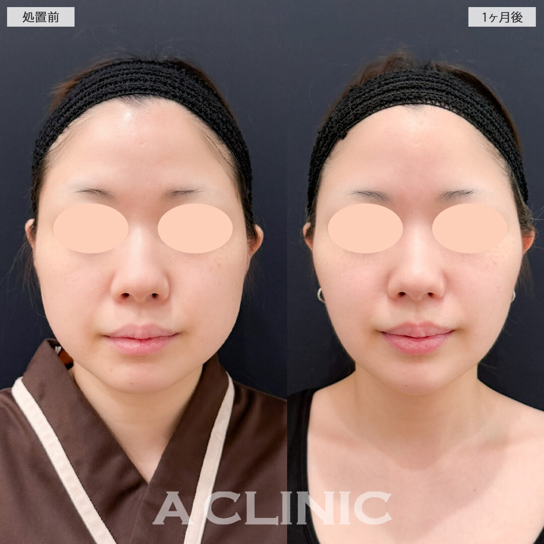 1day小顔脂肪吸引とバッカルファット除去術でお顔のボリューム感を落として一気に小顔に！こちら処置前と1か月後の症例です(20代女性)