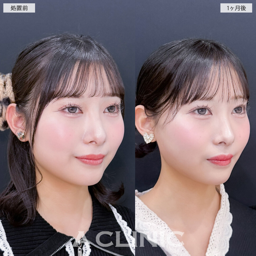 1day小顔脂肪吸引で小顔になって余白が減りました！こちら処置前と1ヶ月後の症例です(20代女性)