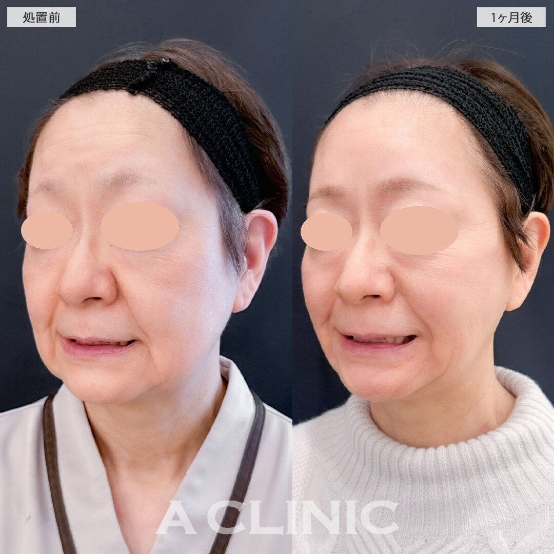 1day小顔脂肪吸引は若返りにも大きな効果が期待できる施術です！こちら処置前と1ヶ月後の症例です(60代女性)