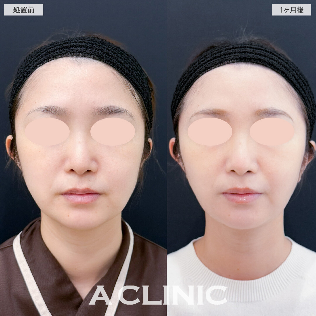 1day小顔脂肪吸引とバッカルファット除去術で余分な脂肪を減らしてすっきりVフェイスに！こちら処置前と1ヶ月後の症例です(30代女性)