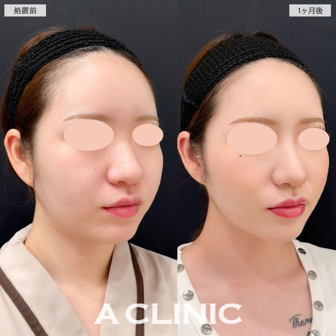 1day小顔脂肪吸引でお顔のボリューム感を減らして垢抜け！こちら処置前と1ヶ月後の症例です(20代女性)