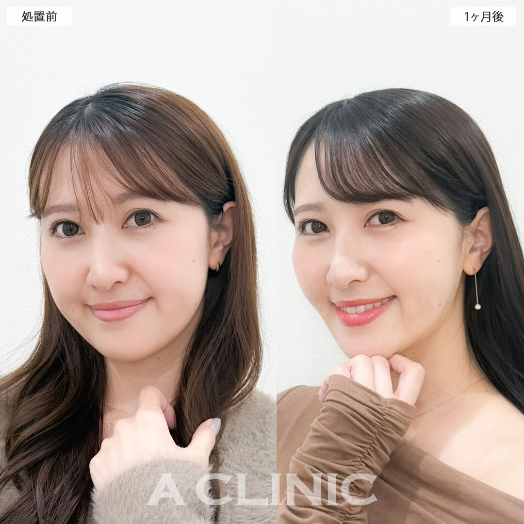 1day小顔脂肪吸引で小顔になって美しさUPしました！こちら処置前と1か月後の症例です(30代女性)