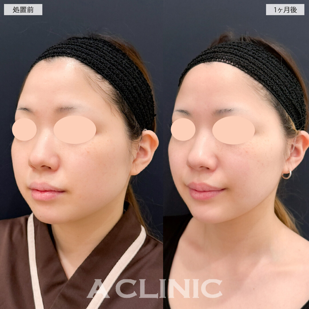 1day小顔脂肪吸引とバッカルファット除去術でお顔のボリューム感を落として一気に小顔に！こちら処置前と1か月後の症例です(20代女性)