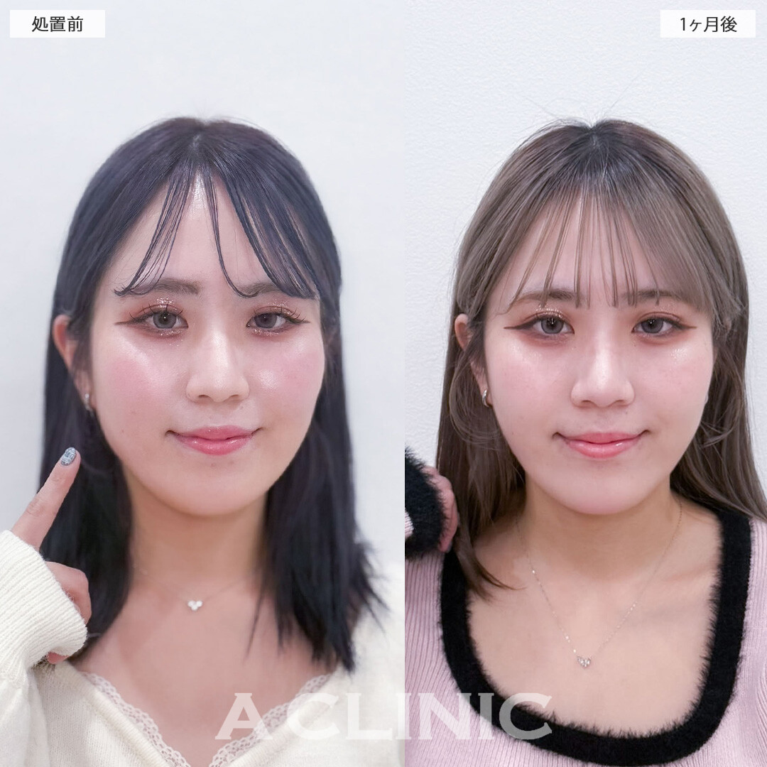 1day小顔脂肪吸引でぷにっと感を無くしてシュッと小顔に！こちら処置前と1ヶ月後の症例です(20代女性)