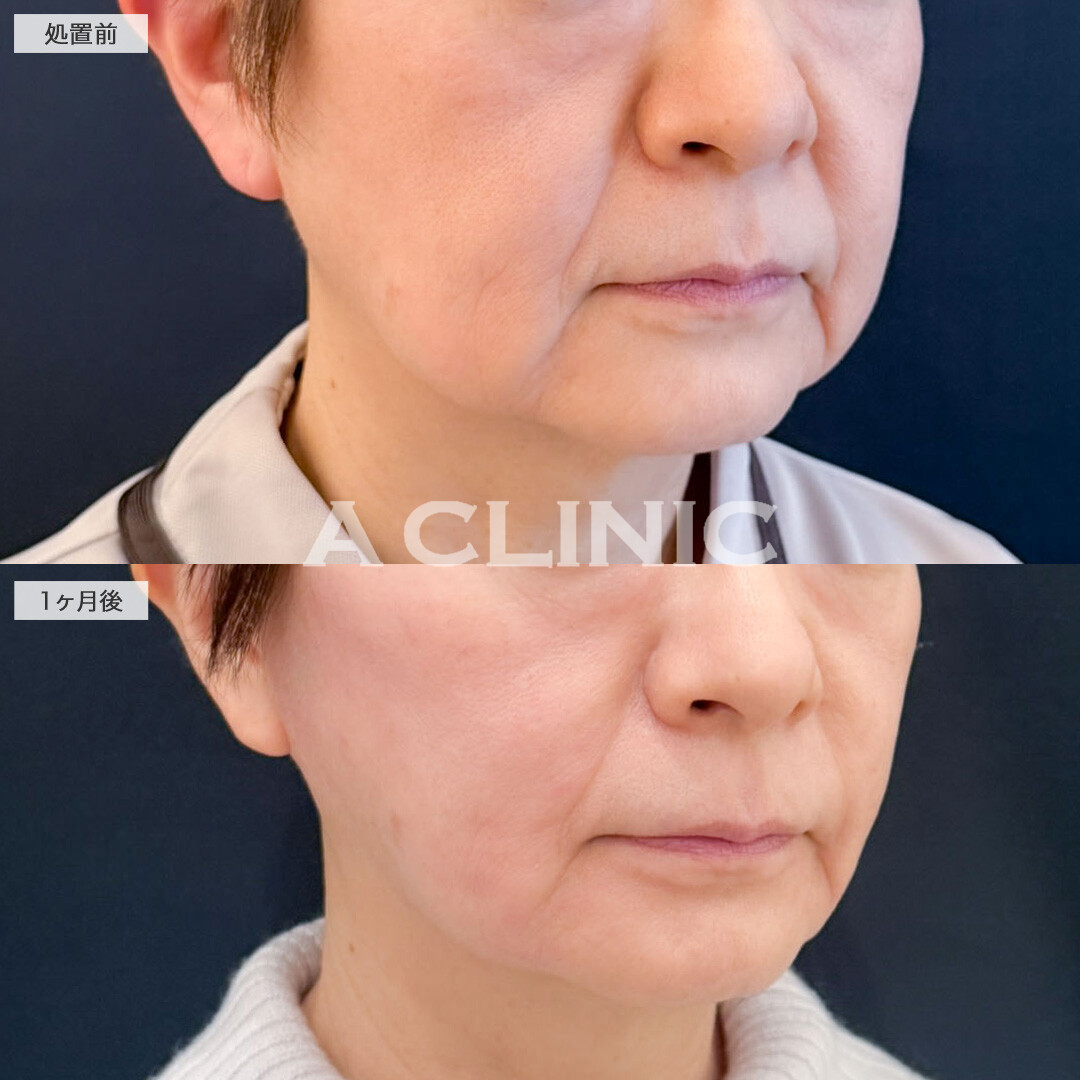 1day小顔脂肪吸引は若返りにも大きな効果が期待できる施術です！こちら処置前と1ヶ月後の症例です(60代女性)