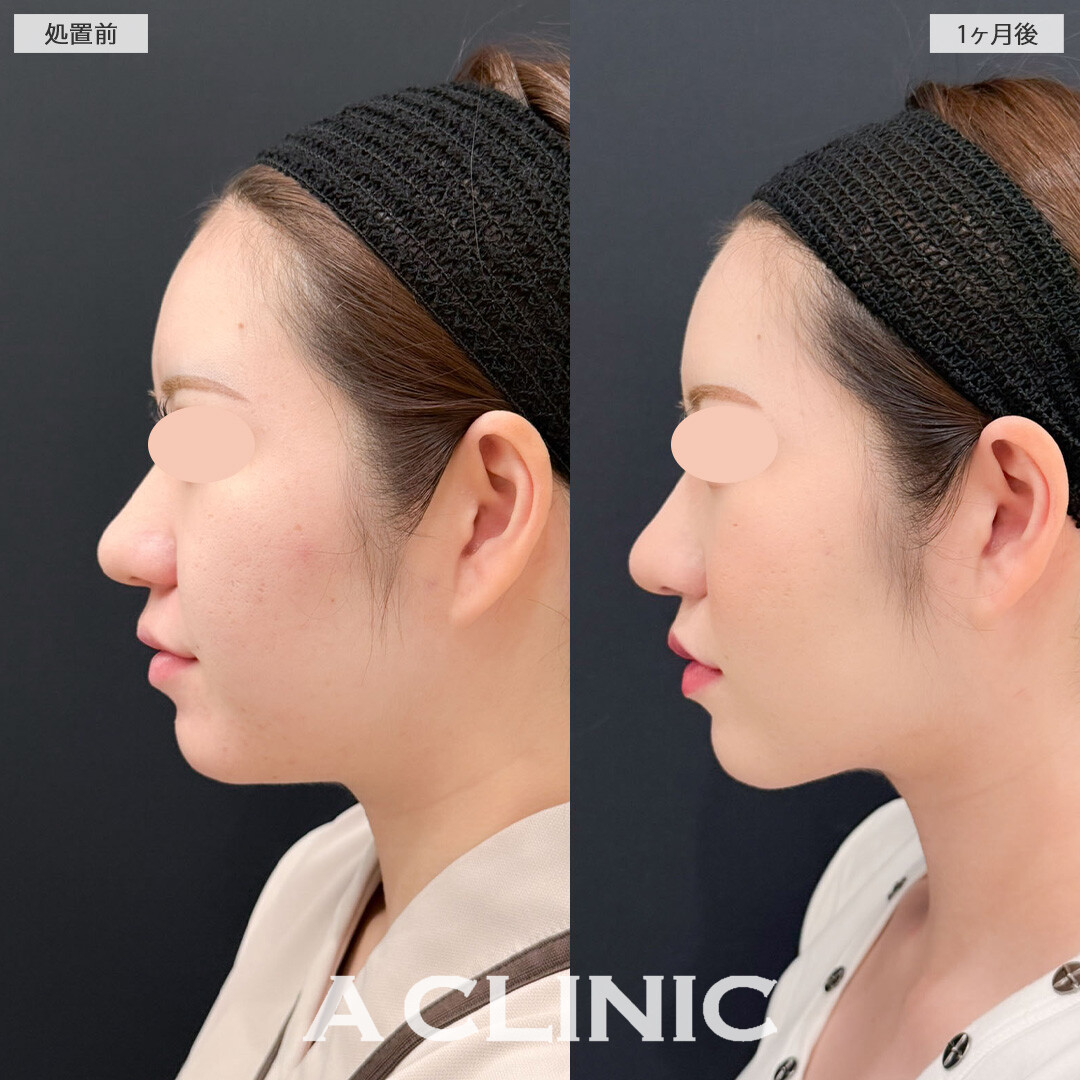 1day小顔脂肪吸引でお顔のボリューム感を減らして垢抜け！こちら処置前と1ヶ月後の症例です(20代女性)