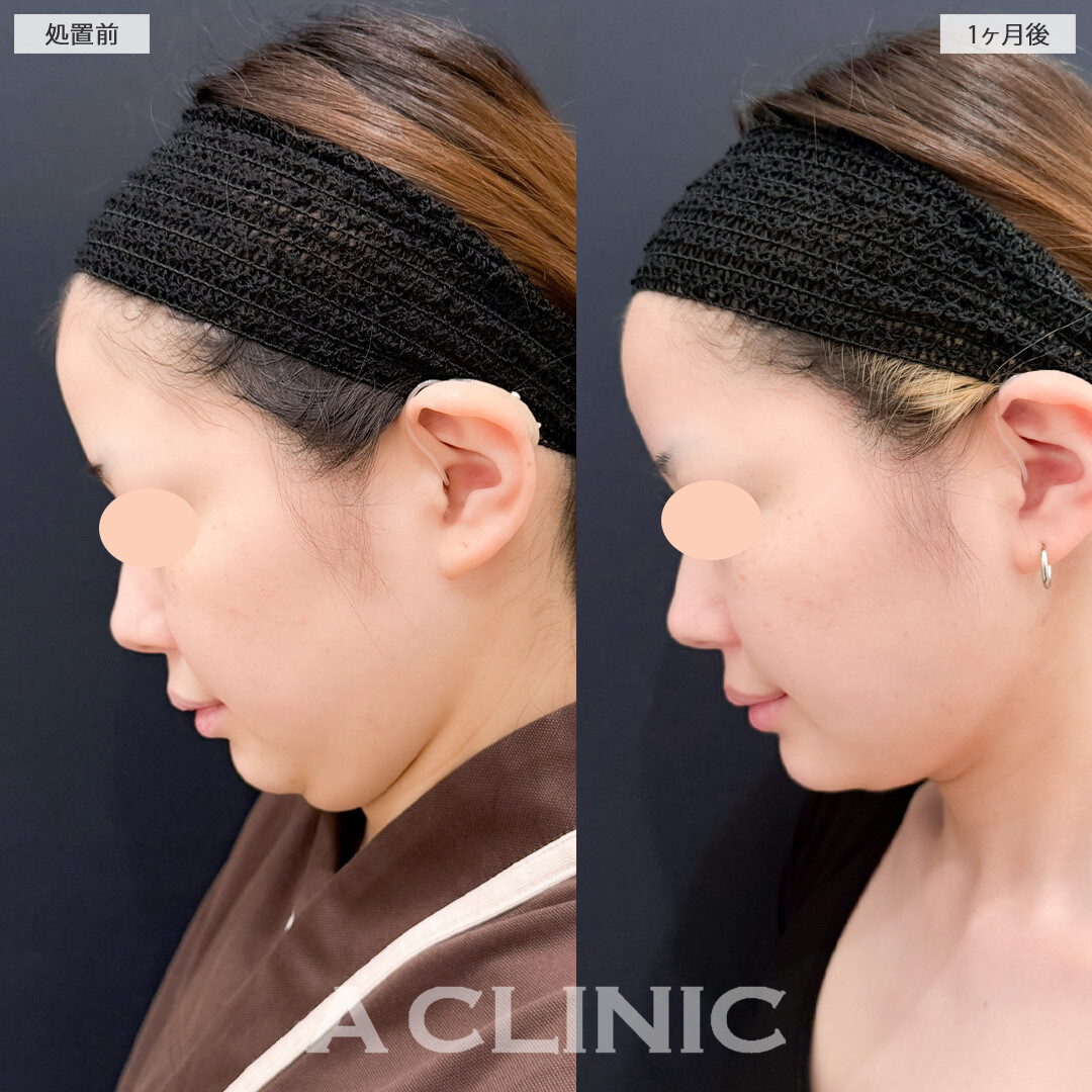 1day小顔脂肪吸引とバッカルファット除去術でお顔のボリューム感を落として一気に小顔に！こちら処置前と1か月後の症例です(20代女性)