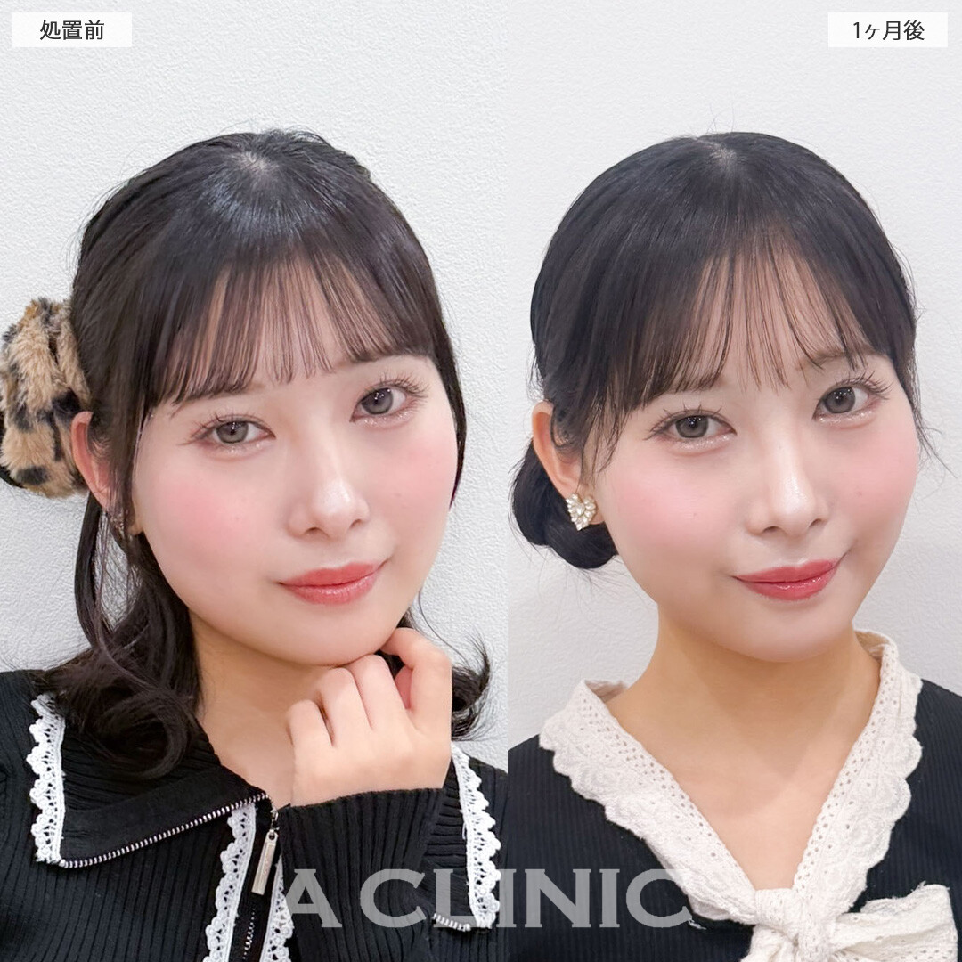 1day小顔脂肪吸引で小顔になって余白が減りました！こちら処置前と1ヶ月後の症例です(20代女性)