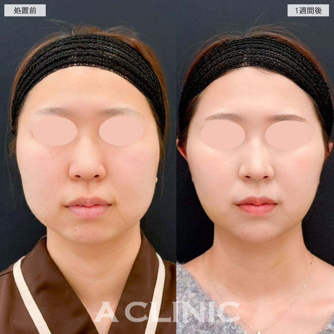 1day小顔脂肪吸引とバッカルファット除去術で丸みを残して自然だけどしっかりアップデート！こちら処置前と1週間後の症例です(20代女性)