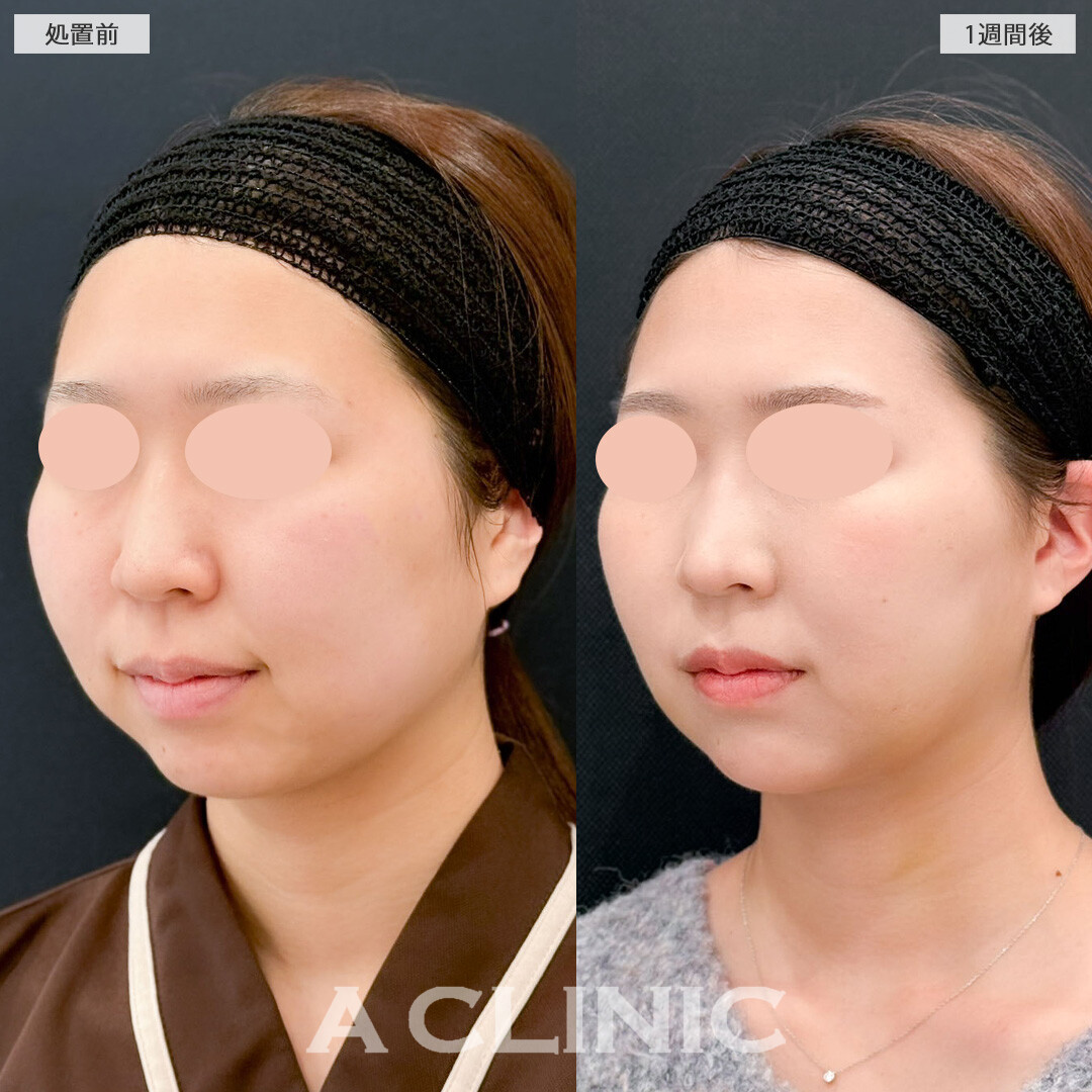 1day小顔脂肪吸引とバッカルファット除去術で丸みを残して自然だけどしっかりアップデート！こちら処置前と1週間後の症例です(20代女性)