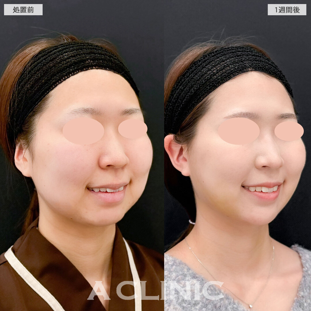 1day小顔脂肪吸引とバッカルファット除去術で丸みを残して自然だけどしっかりアップデート！こちら処置前と1週間後の症例です(20代女性)