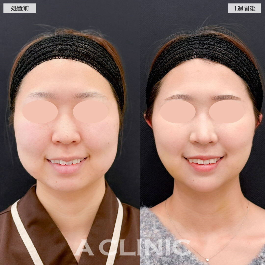 1day小顔脂肪吸引とバッカルファット除去術で丸みを残して自然だけどしっかりアップデート！こちら処置前と1週間後の症例です(20代女性)