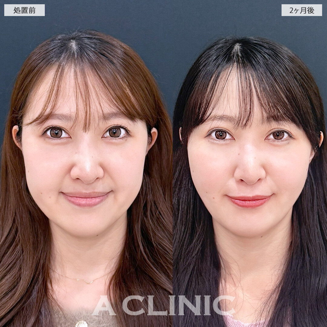 1day小顔脂肪吸引とバッカルファット除去術で余分な脂肪を残さず除去！こちら処置前と2か月後の症例です(30代女性)
