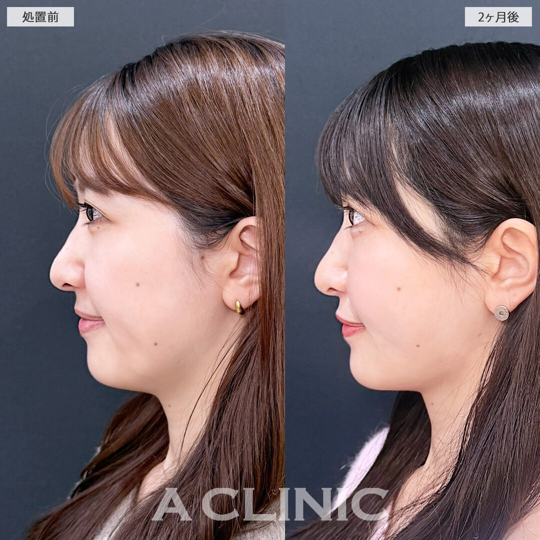 1day小顔脂肪吸引とバッカルファット除去術で余分な脂肪を残さず除去！こちら処置前と2か月後の症例です(30代女性)